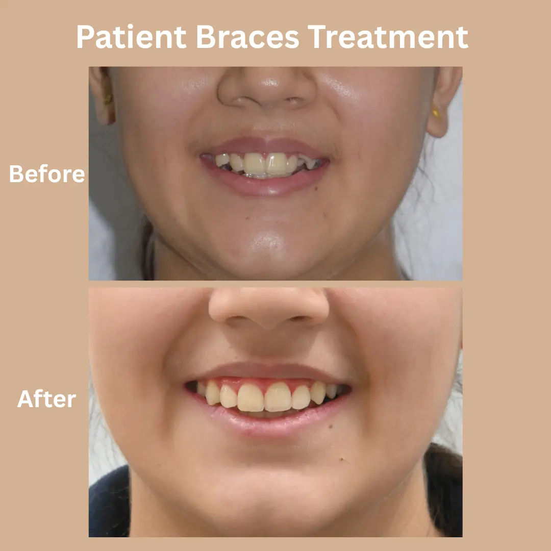 Patient Braces Treatment Before And After