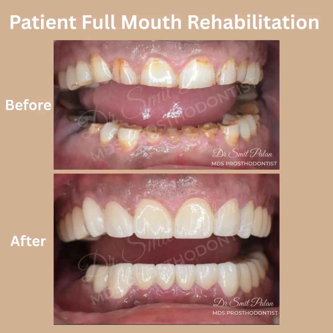 Patient Full Mouth Rehabilitation Before And After