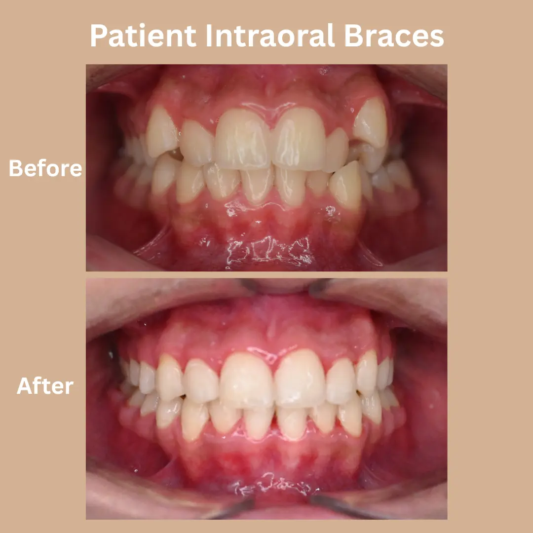 Patient Intraoral Braces Before And After