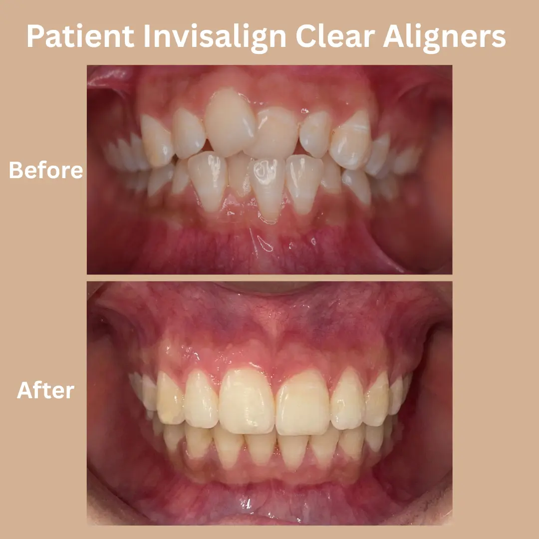 Patient Invisalign Clear Aligners Before and After