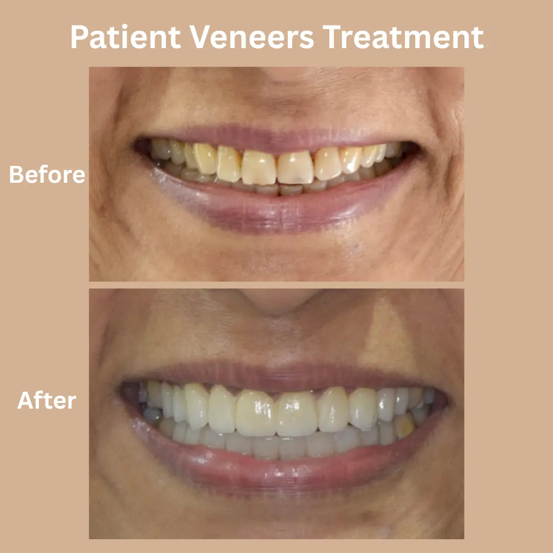 Patient Veneers Before And After